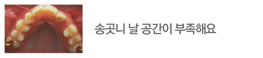 송곳니 날 공간이 부족해요