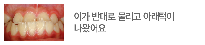 이가 반대로 물리고 아래턱이 나왔어요