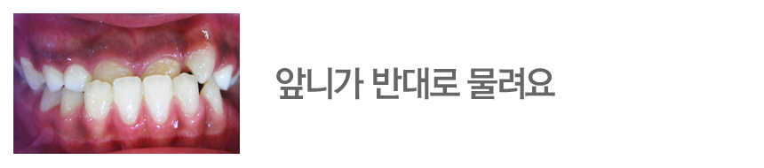 앞니가 반대로 물려요