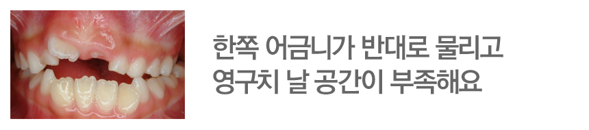 한쪽 어금니가 반대로 물리고 영구치 날 공간이 부족해요