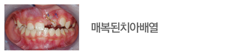 매복된치아배열