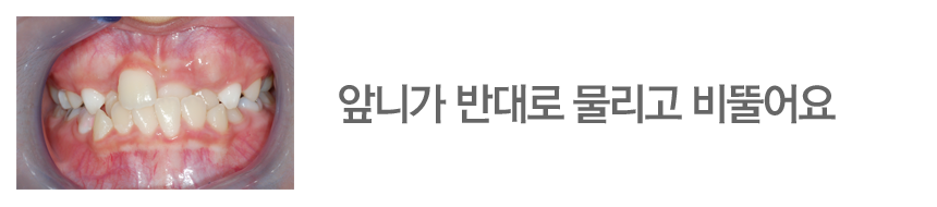 앞니가 반대로 물리고 비뚤어요
