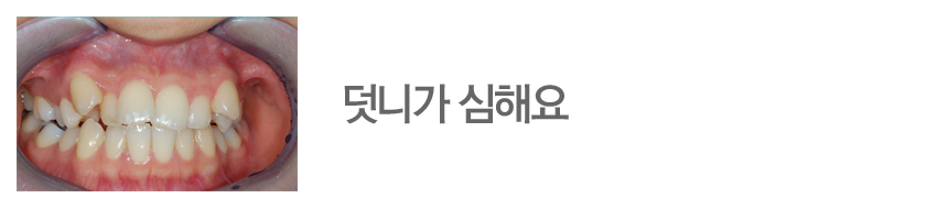 덧니가 심해요
