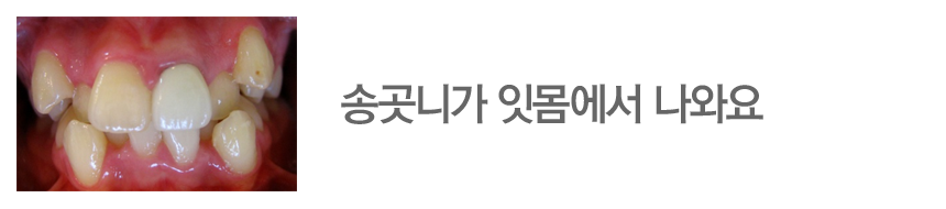 송곳니가 잇몸에서 나와요