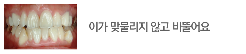 이가 맞물리지 않고 비뚤어요