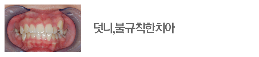 덧니,불규칙한치아