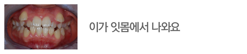 이가 잇몸에서 나와요