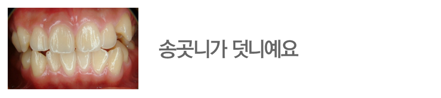 송곳니가 덧니예요