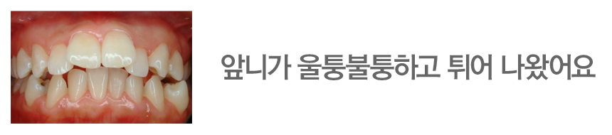 앞니가 울퉁불퉁하고 튀어 나왔어요