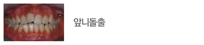 앞니돌출
