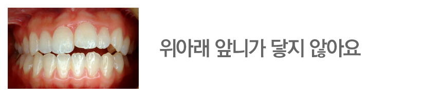 위아래 앞니가 닿지 않아요