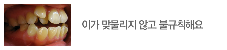 이가 맞물리지 않고 불규칙해요