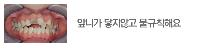 앞니가 닿지않고 불규칙해요