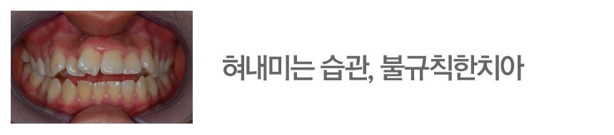 혀내미는 습관, 불규칙한치아