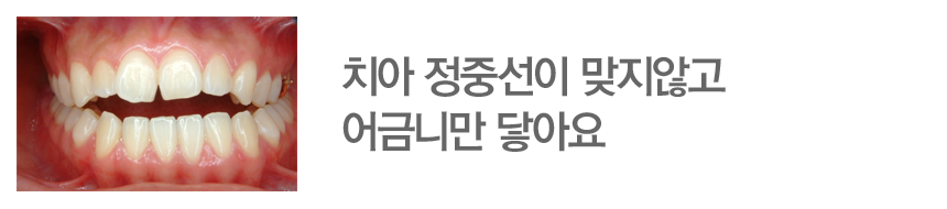 치아 정중선이 맞지않고 어금니만 닿아요