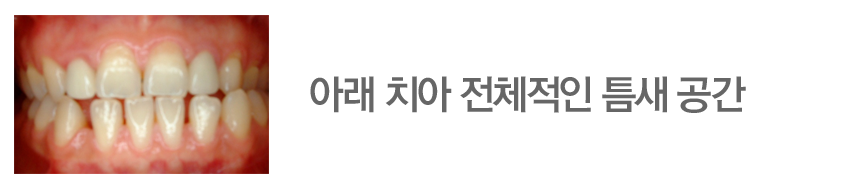 아래 치아 전체적인 틈새 공간