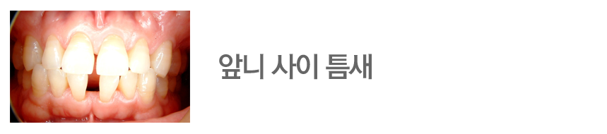 앞니 사이 틈새