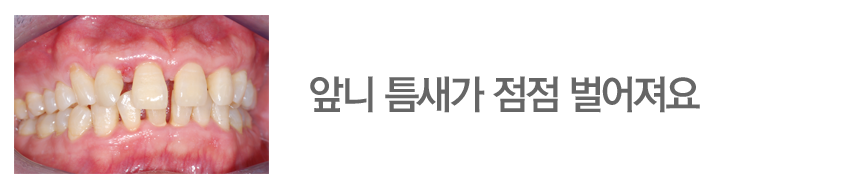 앞니 틈새가 점점 벌어져요