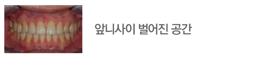 앞니사이 벌어진 공간