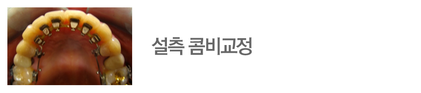 설측 콤비교정