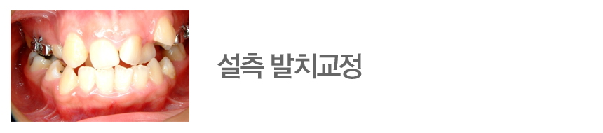 설측 발치교정