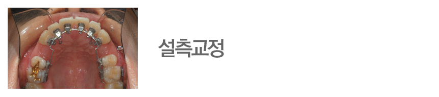설측교정