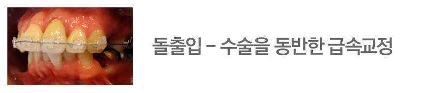 돌출입 - 수술을 동반한 급속교정