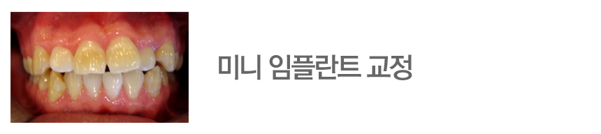 미니 임플란트 교정