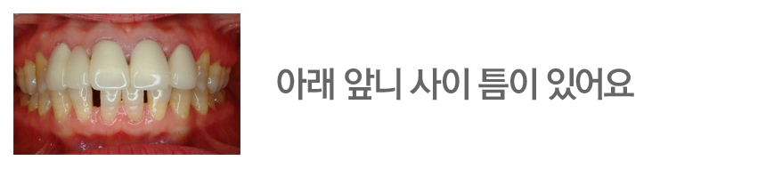 아래 앞니 사이 틈이 있어요