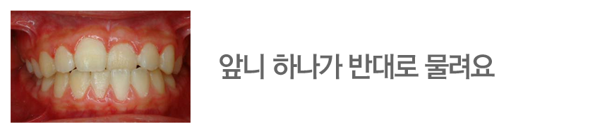 앞니 하나가 반대로 물려요