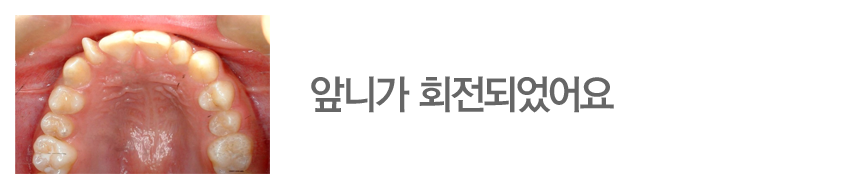 앞니가 회전되었어요