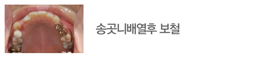 송곳니배열후 보철
