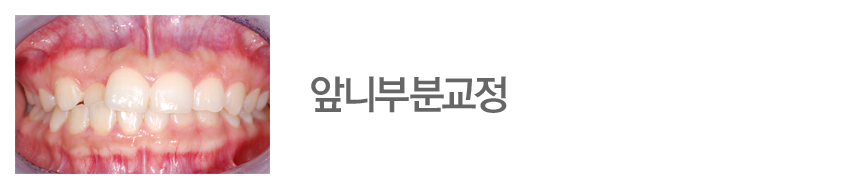 앞니부분교정