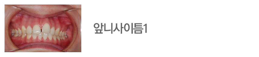 앞니사이틈1