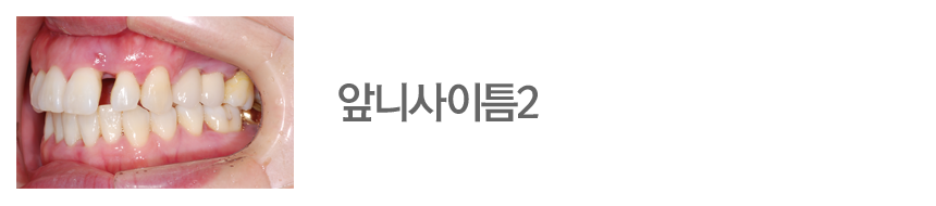 앞니사이틈2