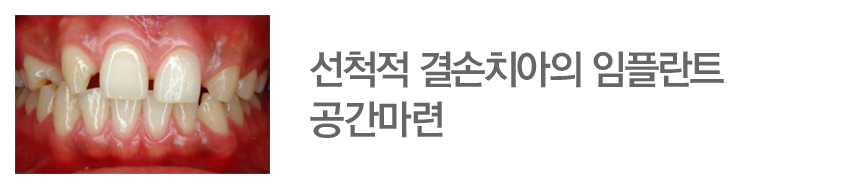 선천적 결손치아의 임플란트 공간마련