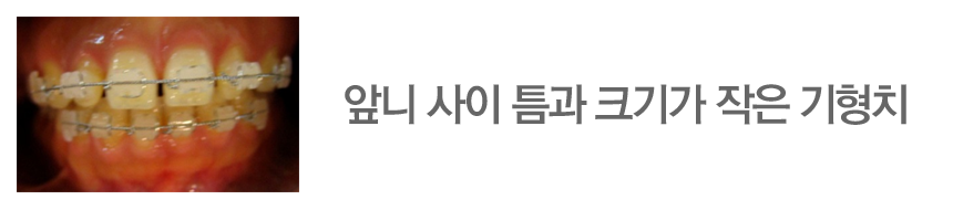 앞니 사이 틈과 크기가 작은 기형치