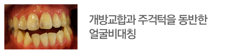 개방교합과 주걱턱을 동반한 얼굴비대칭