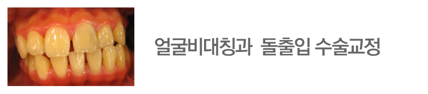 얼굴비대칭과  돌출입 수술교정