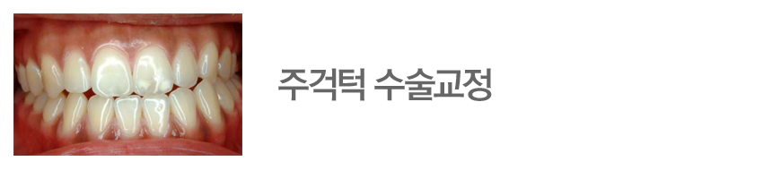 주걱턱 수술교정