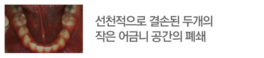 선천적으로 결손된 두개의 작은 어금니 공간의 폐쇄