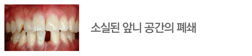 소실된 앞니 공간의 폐쇄