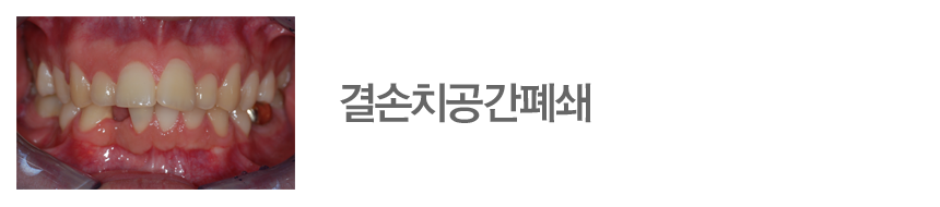 결손치공간폐쇄