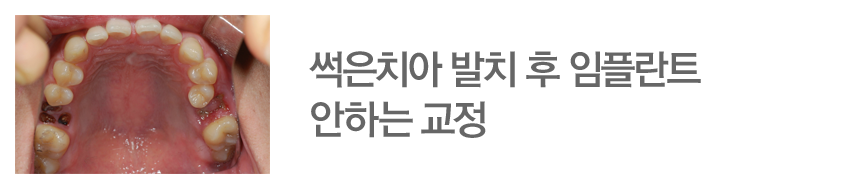 썩은치아 발치 후 임플란트 안하는 교정