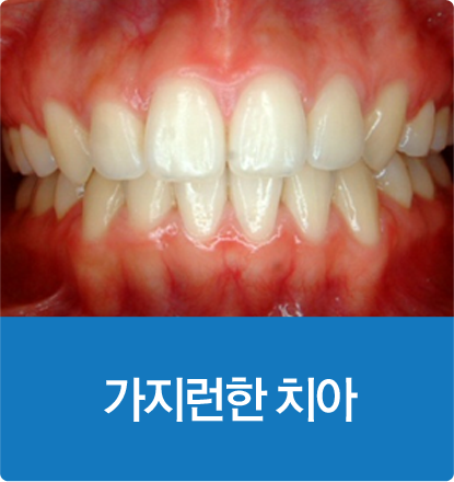 가지런한 치아