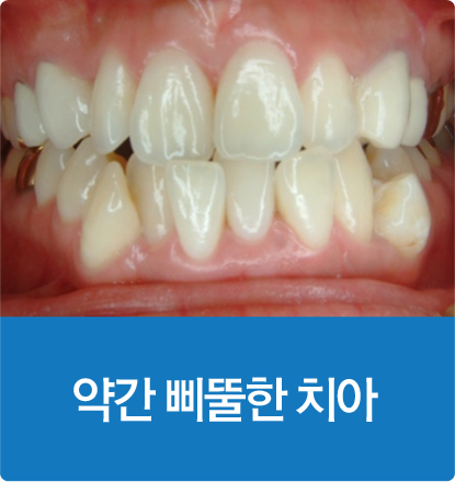 약간 삐뚤한 치아