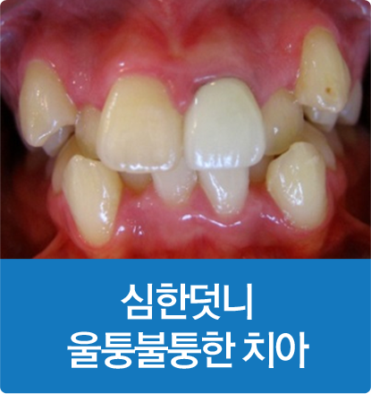심한덧니 울퉁불퉁한 치아