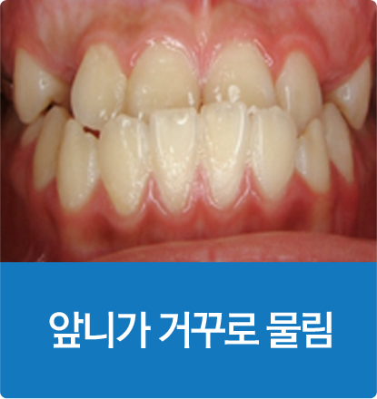 앞니가 거꾸로 물림