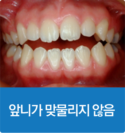 앞니가 맞물리지 않음