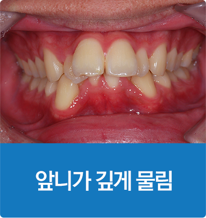 앞니가 깊게 물림